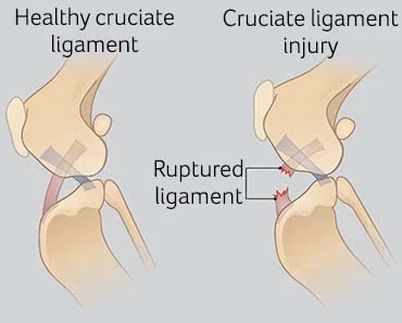 Healthy and ruptured cruciate ligament