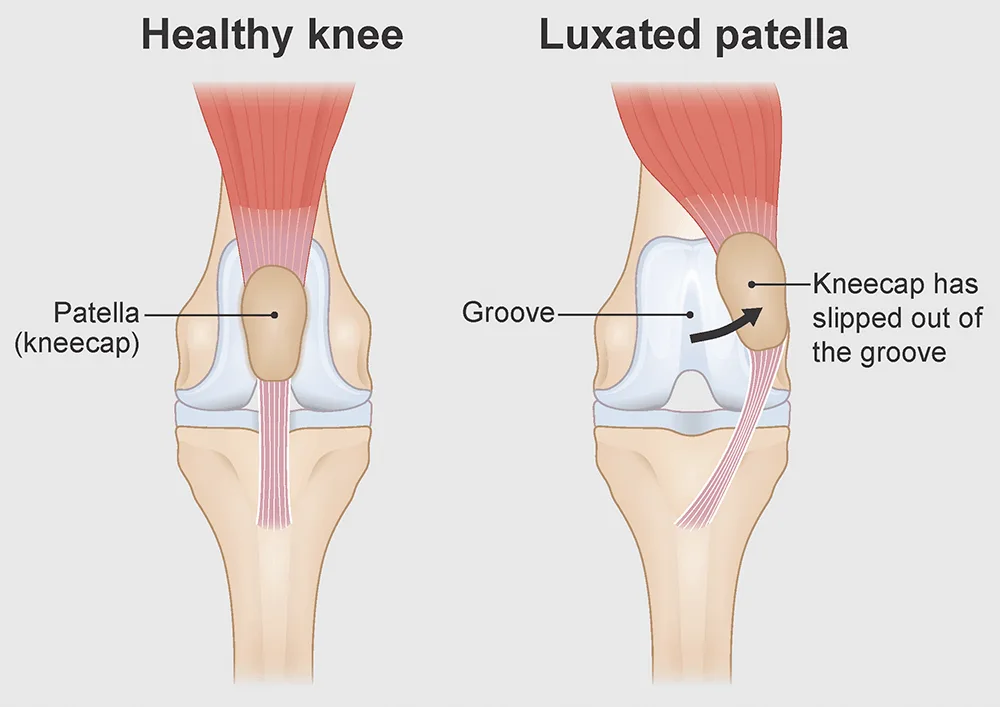 Healthy knee and luxated patella