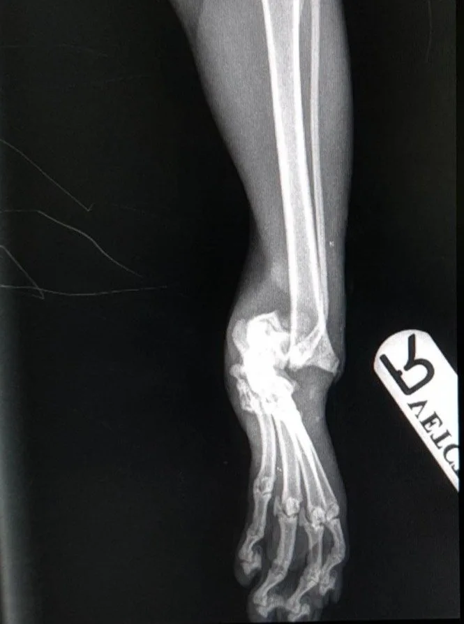 Matilda X-ray before surgery