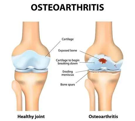 Healthy joint compared with osteoarthritis